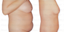 Microcannular liposuction on the upper belly and lower belly