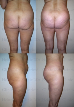 Microcannular liposuction on upper belly, lower belly, hips, outer thighs, inner thighs, buttocks, and dent correction