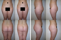 Microcannular liposuction on upper belly, lower belly, and hips