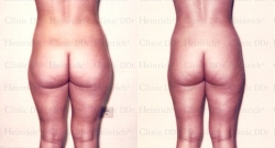 Microcannular liposuction on buttocks and outer thighs