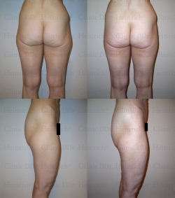 Microcannular liposuction on outer thighs and inner thighs (slightly)