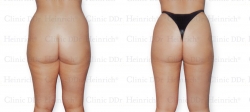 Microcannular liposuction on hips, outer thighs, and inner thighs