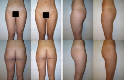 Microcannular liposuction on waist, hips, buttocks, outer thighs, and inner thighs