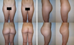Microcannular liposuction on buttocks and outer thighs