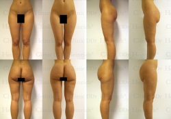Microcannular liposuction on hips, buttocks, outer thighs, inner thighs, and lower legs