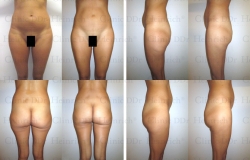 Microcannular liposuction on belly, hips, buttocks, and outer thighs